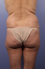 Liposuction Before and after photo