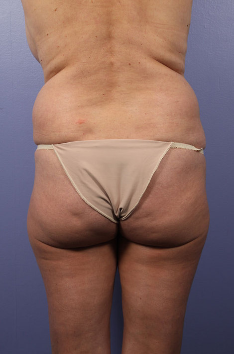 Liposuction before and after photo