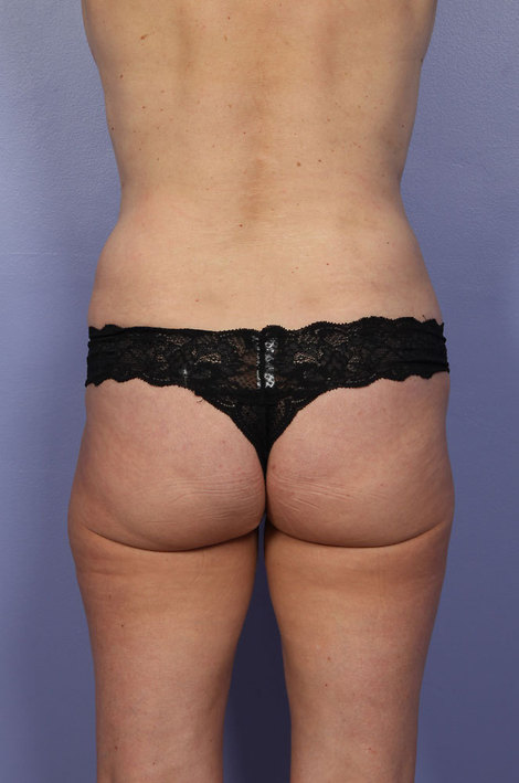 Liposuction before and after photo