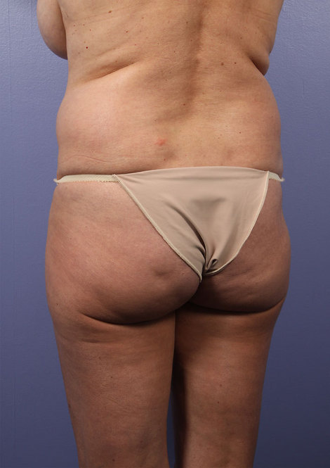 Liposuction before and after photo