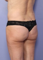 Liposuction Before and after photo