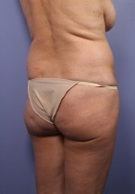 Liposuction Before and after photo