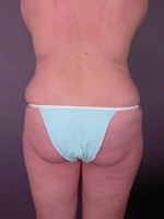 Liposuction Before and after photo