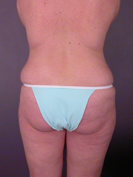 Liposuction before and after photo