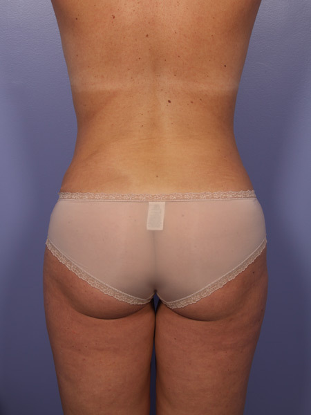 Liposuction before and after photo