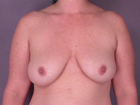 Liposuction before and after photo