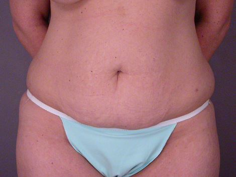 Liposuction before and after photo