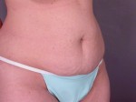 Liposuction Before and after photo