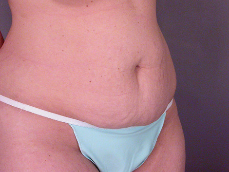 Liposuction before and after photo