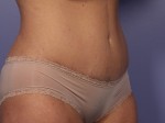 Liposuction Before and after photo