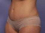 Liposuction Before and after photo