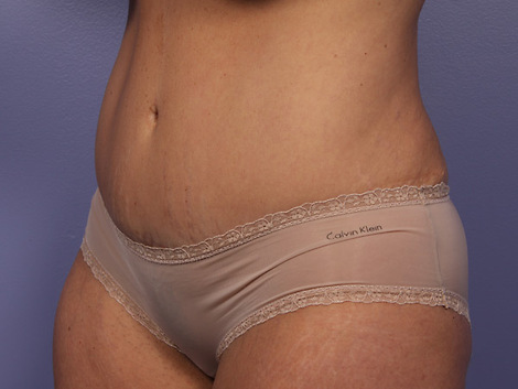 Liposuction before and after photo