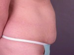 Liposuction Before and after photo