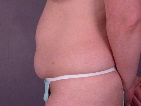 Liposuction before and after photo