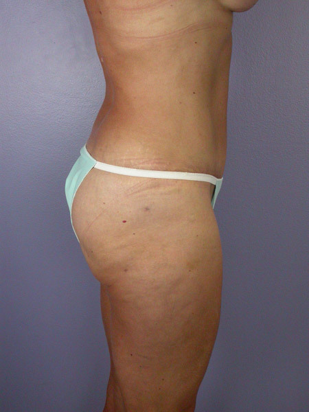 Liposuction before and after photo