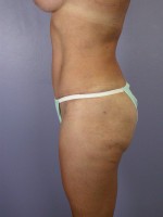 Liposuction Before and after photo