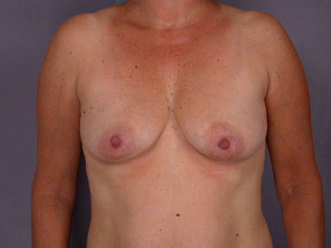 Liposuction before and after photo