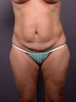 Liposuction Before and after photo