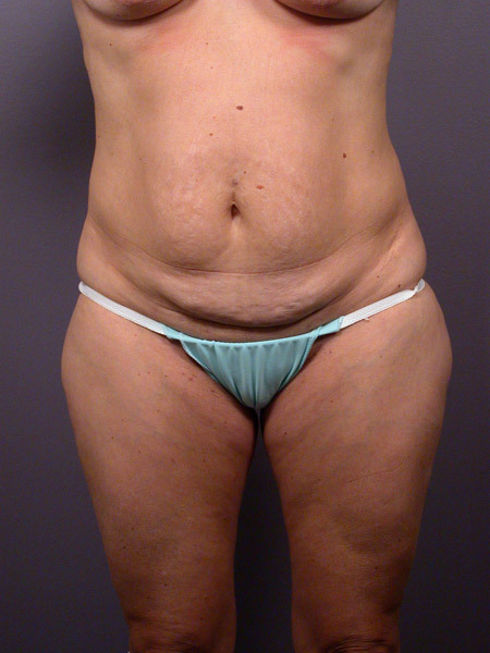 Liposuction before and after photo