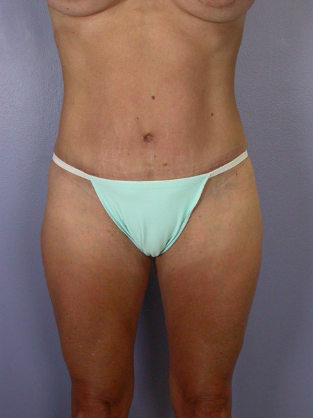 Liposuction before and after photo