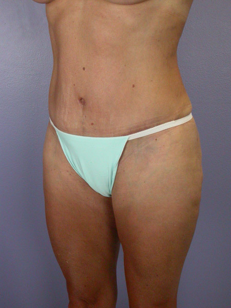 Liposuction before and after photo