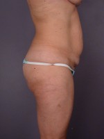 Liposuction Before and after photo