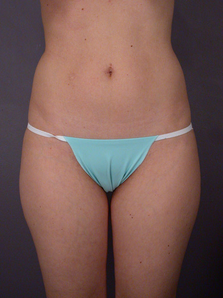 Liposuction before and after photo