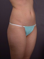 Liposuction Before and after photo