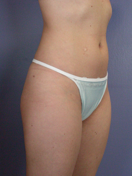 Liposuction before and after photo