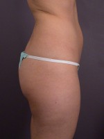 Liposuction Before and after photo