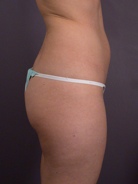 Liposuction before and after photo