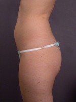 Liposuction Before and after photo