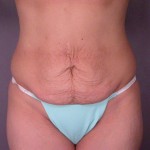 Liposuction Before and after photo