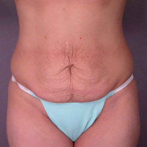 Liposuction before and after photo