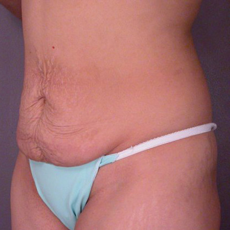 Liposuction before and after photo