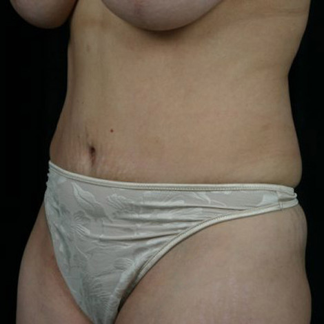 Liposuction before and after photo