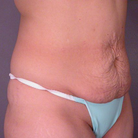 Liposuction before and after photo