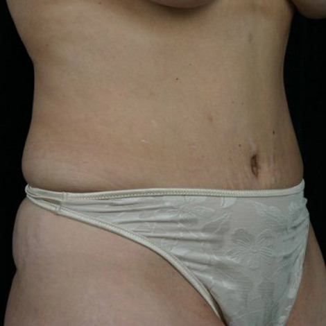 Liposuction before and after photo