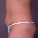 Liposuction Before and after photo