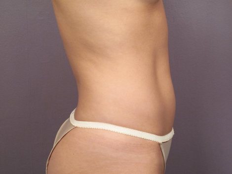 Liposuction before and after photo