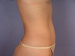 Liposuction Before and after photo