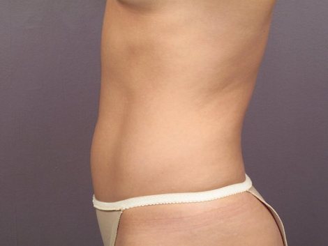 Liposuction before and after photo