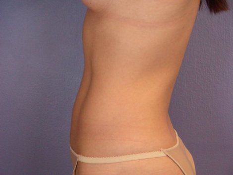 Liposuction before and after photo