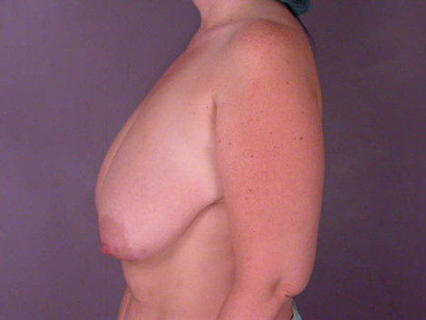 Liposuction before and after photo