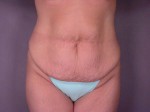 Liposuction Before and after photo