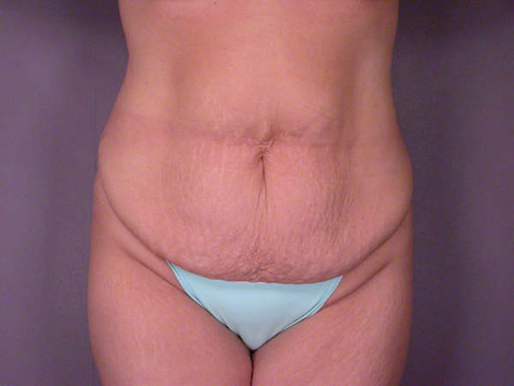 Liposuction before and after photo