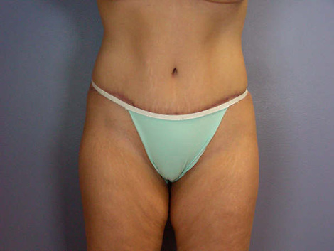 Liposuction before and after photo