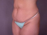 Liposuction Before and after photo