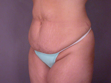 Liposuction before and after photo