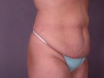 Liposuction Before and after photo